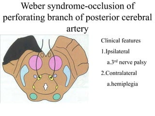 Weber syndrome-occlusion of
perforating branch of posterior cerebral
artery
Clinical features
1.Ipsilateral
a.3rd nerve palsy
2.Contralateral
a.hemiplegia
 