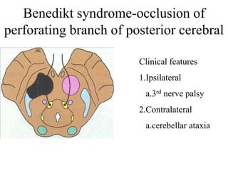 Benedikt syndrome-occlusion of
perforating branch of posterior cerebral
Clinical features
1.Ipsilateral
a.3rd nerve palsy
2.Contralateral
a.cerebellar ataxia
 