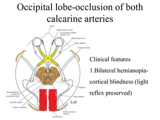 Occipital lobe-occlusion of both
calcarine arteries
Clinical features
1.Bilateral hemianopia-
cortical blindness (light
reflex preserved)
 