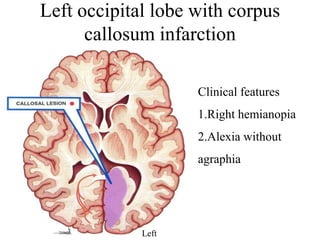 Left occipital lobe with corpus
callosum infarction
Left
Clinical features
1.Right hemianopia
2.Alexia without
agraphia
 