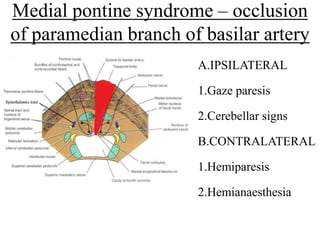 Medial pontine syndrome – occlusion
of paramedian branch of basilar artery
A.IPSILATERAL
1.Gaze paresis
2.Cerebellar signs
B.CONTRALATERAL
1.Hemiparesis
2.Hemianaesthesia
 