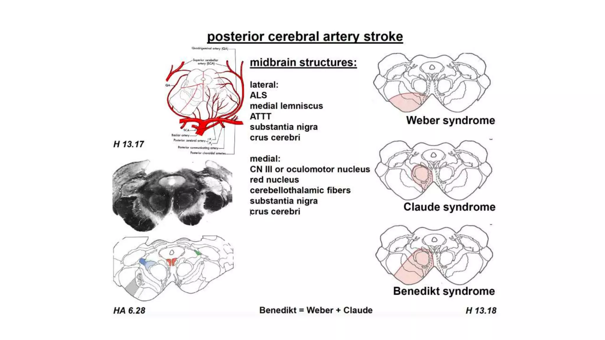 posterior-circulation-stroke-syndromes-dr-sameep-koshti-consultant