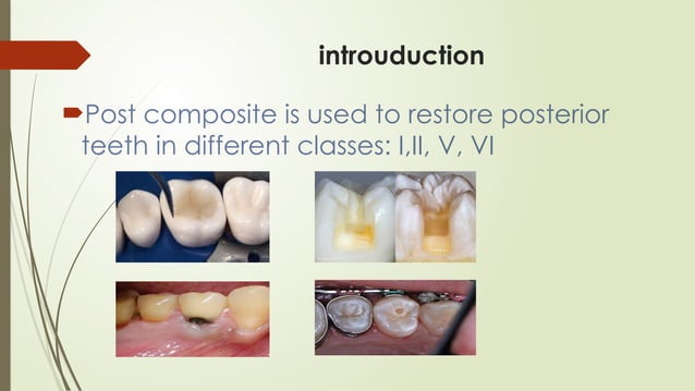 Posterior composite restorations my pres.pptx | Dental Health ...