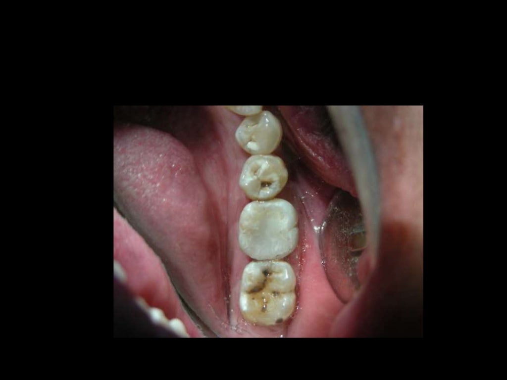 Posterior composites