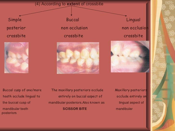 Posterior crossbite in_primary_and_mixed_dentition__etiology_and_man…