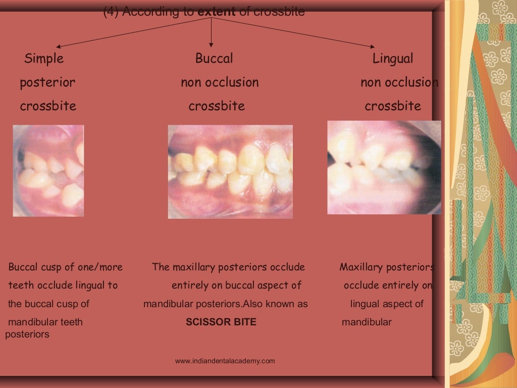 Posterior crossbite in_primary_and_mixed_dentition_-_etiology_and_man…