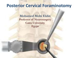 Posterior Cervical Foraminotomy
Mohamed Mohi Eldin
Professor of Neurosurgery
Cairo University
Egypt
 