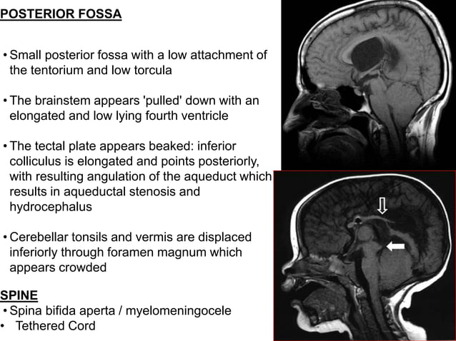 Posterior fossa malformations | PPTX | Brain and Nervous System ...