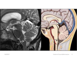 Posterior fossa malformations | PPTX