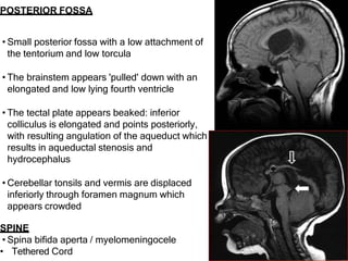 posteriorfossamalformations-170608150351 (1).pptx