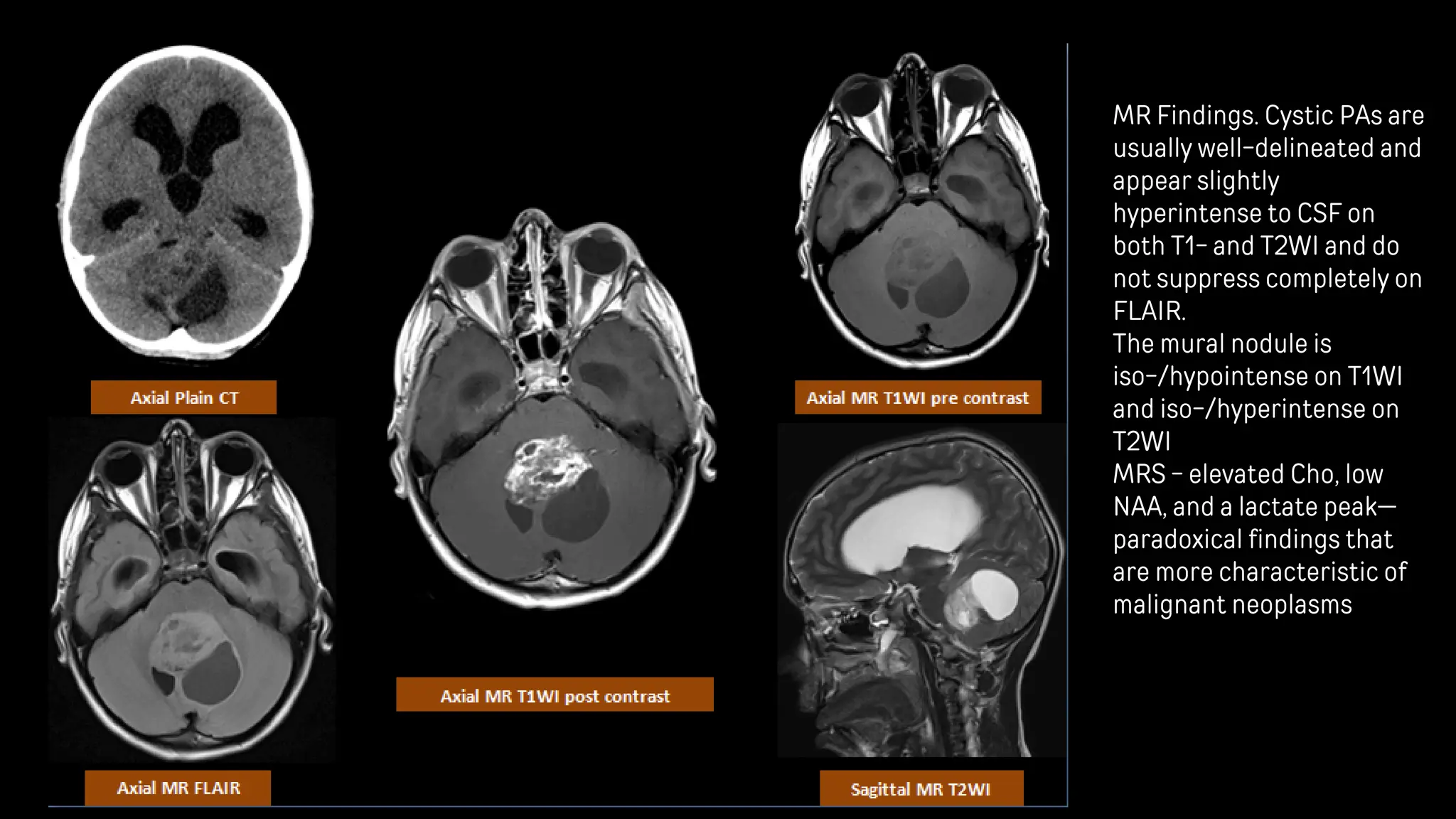 Posterior fossa tumours - Head and neck radiology pdf | PDF