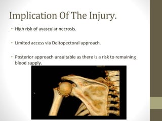 Implication Of The Injury.
• High risk of avascular necrosis.
• Limited access via Deltopectoral approach.
• Posterior approach unsuitable as there is a risk to remaining
blood supply.
 