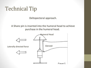 Technical Tip
Deltopectoral approach.
A Shanz pin is inserted into the humeral head to achieve
purchase in the humeral head.
GlenoidLaterally directed force
Humeral Head
 