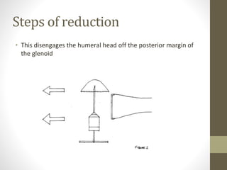 Steps of reduction
• This disengages the humeral head off the posterior margin of
the glenoid
 