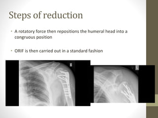 Steps of reduction
• A rotatory force then repositions the humeral head into a
congruous position
• ORIF is then carried out in a standard fashion
 