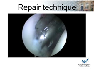 Repair technique
 