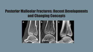 Posterior Malleolar Fractures: Recent Developments
and Changing Concepts
 