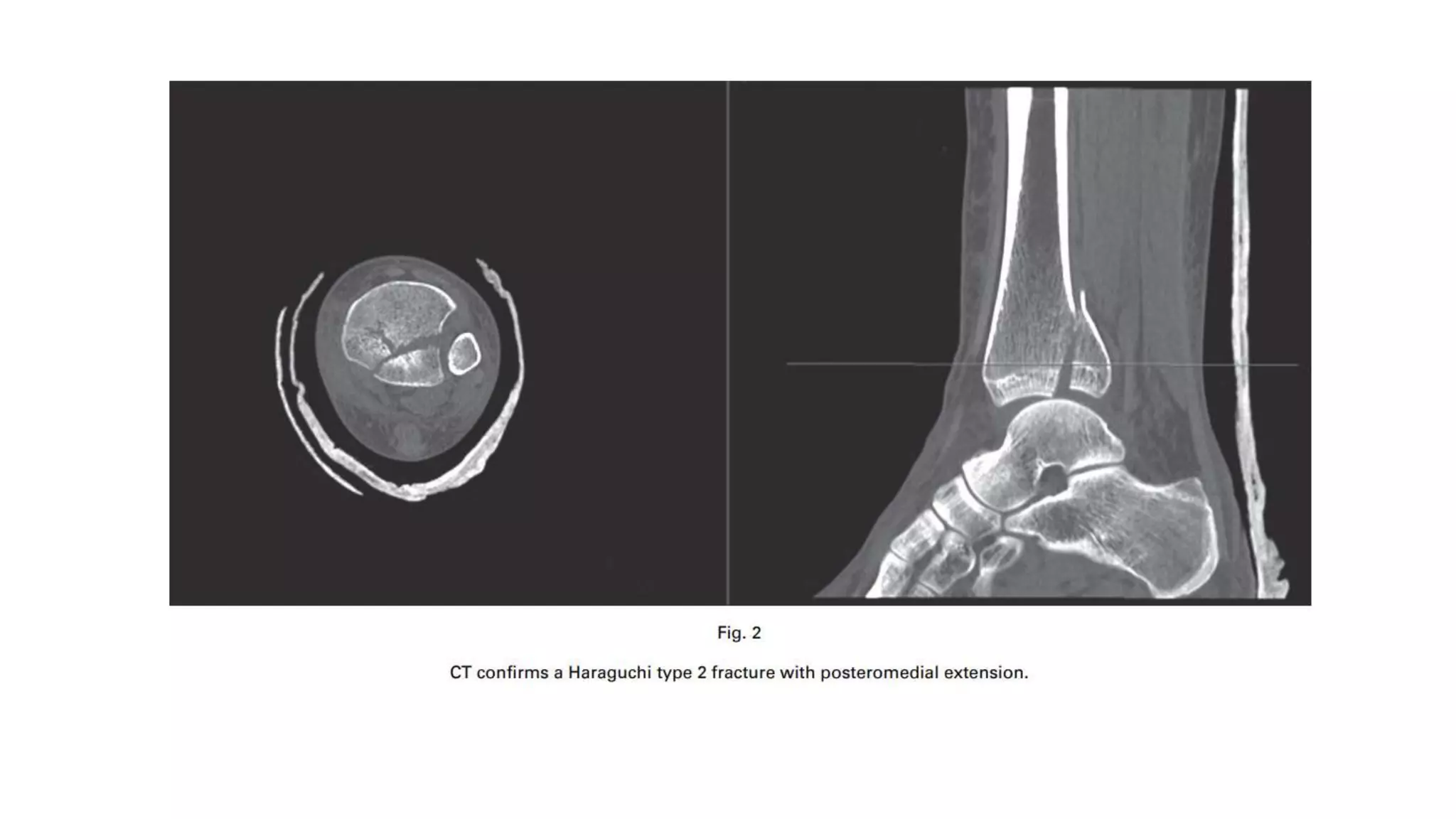 posterior-malleolus-fracture-pptx
