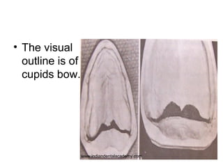 • The visual
outline is of
cupids bow.

www.indiandentalacademy.com

 