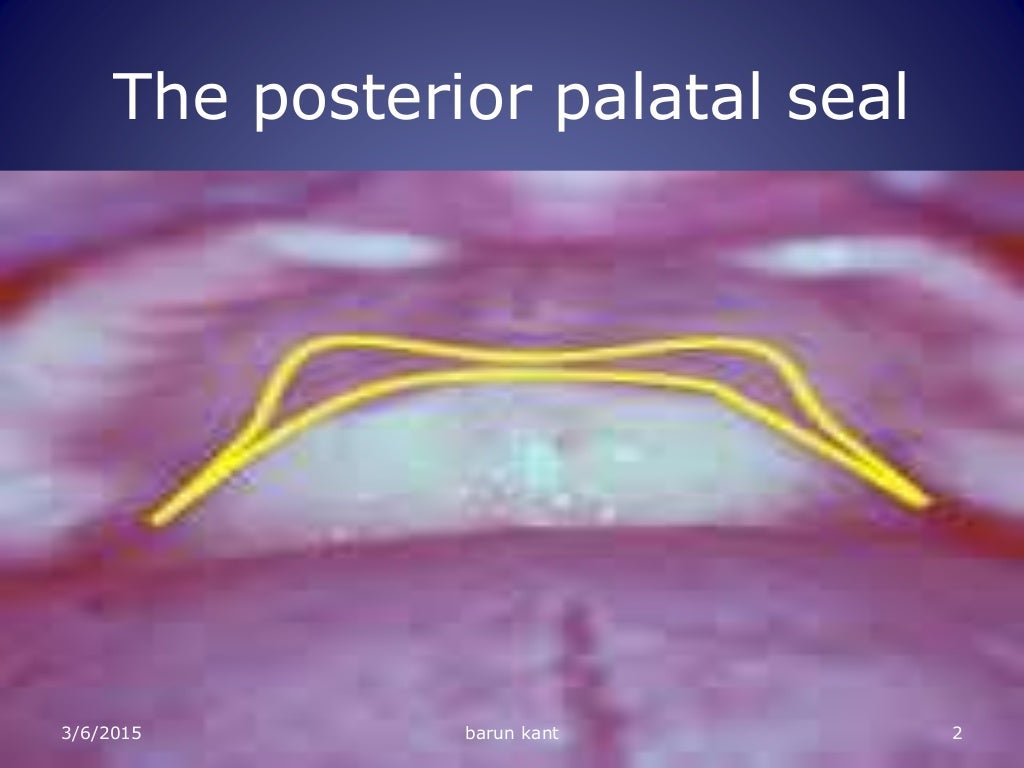 Posterior palatal seal
