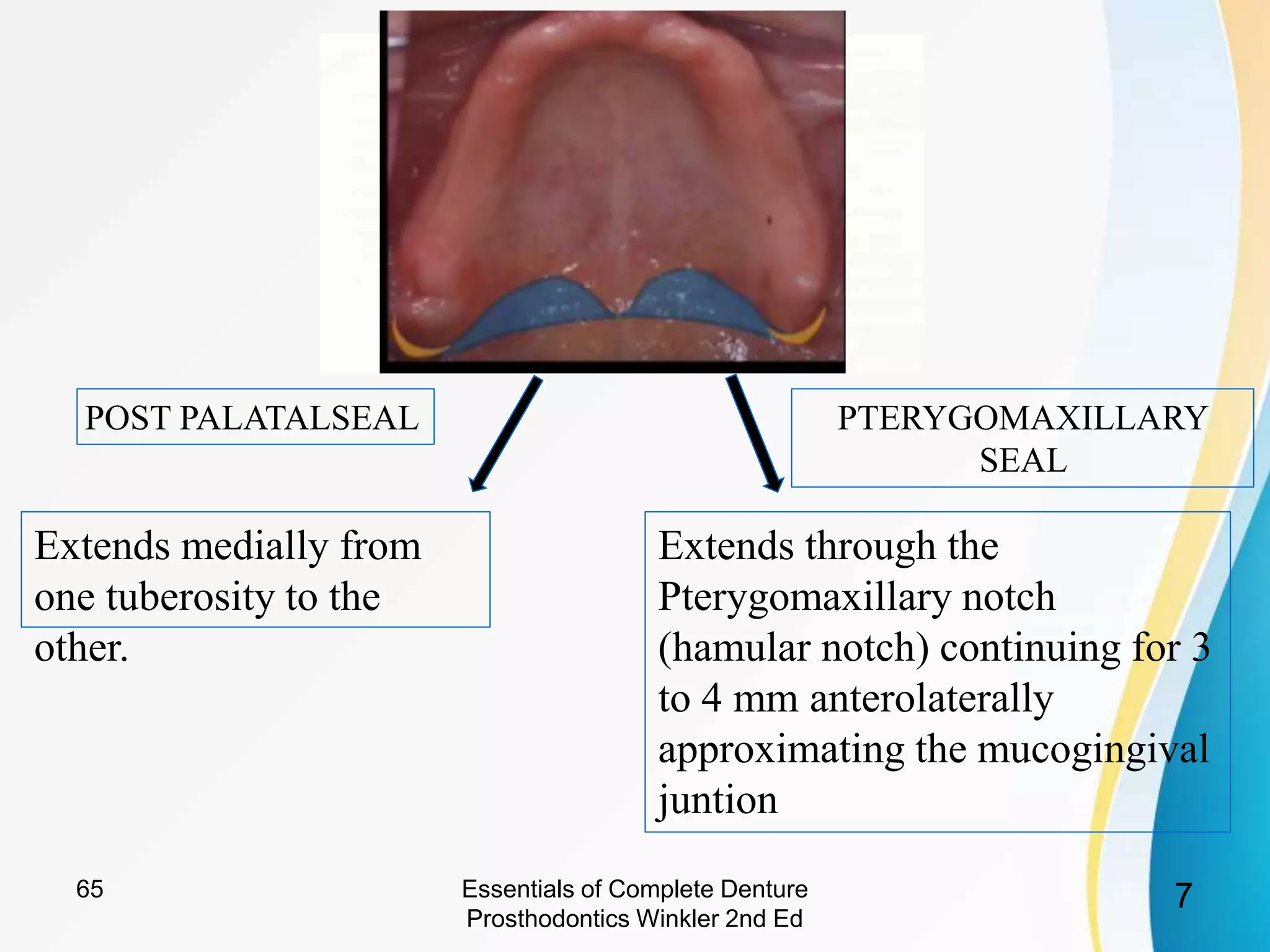 Posterior Palatal Seal Ppt