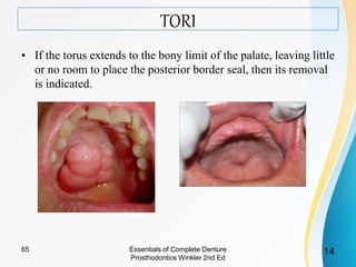 TORI
• If the torus extends to the bony limit of the palate, leaving little
or no room to place the posterior border seal, then its removal
is indicated.
Essentials of Complete Denture
Prosthodontics Winkler 2nd Ed
1465
 