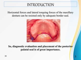 INTRODUCTION
Horizontal forces and lateral torquing forces of the maxillary
denture can be resisted only by adequate border seal.
So, diagnostic evaluation and placement of the posterior
palatal seal is of great importance.
365
 