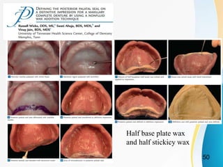 Half base plate wax
and half stickicy wax
50
 