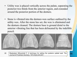 • Utility wax is placed vertically across the palate, separating the
posterior two thirds from the anterior region, and extended
around the posterior portion of the denture.
• Stone is vibrated into the denture-wax surface outlined by the
utility wax. After the stone has set, the wax is eliminated and
the denture cleaned. The denture base is ground distal to the
anterior vibrating line that has been delineated by the indelible
pencil.
Moghadam BScandrett F. A technique for adding the posterior palatal seal. The
Journal of Prosthetic Dentistry. 1974;32(4):443-447.
5865
 