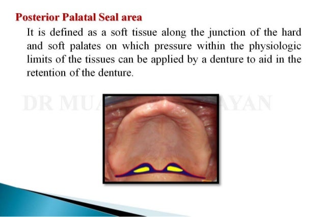 posterior palatal seal