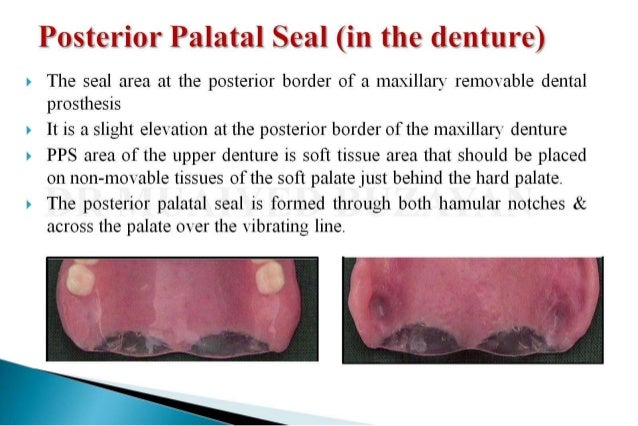 posterior palatal seal