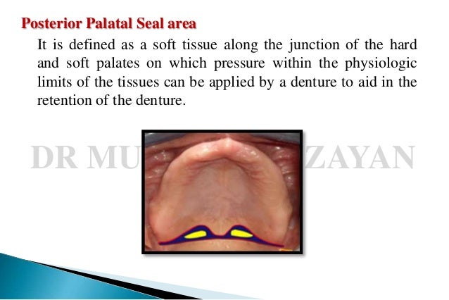 posterior palatal seal