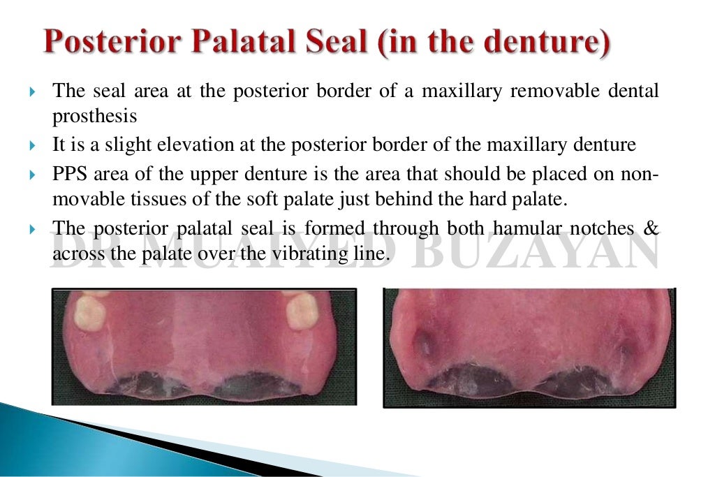 Posterior palatal seal 2nd yr