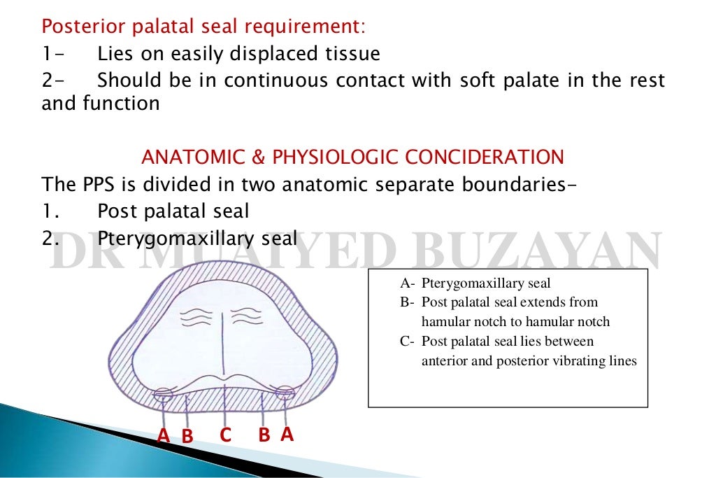 Posterior palatal seal 2nd yr