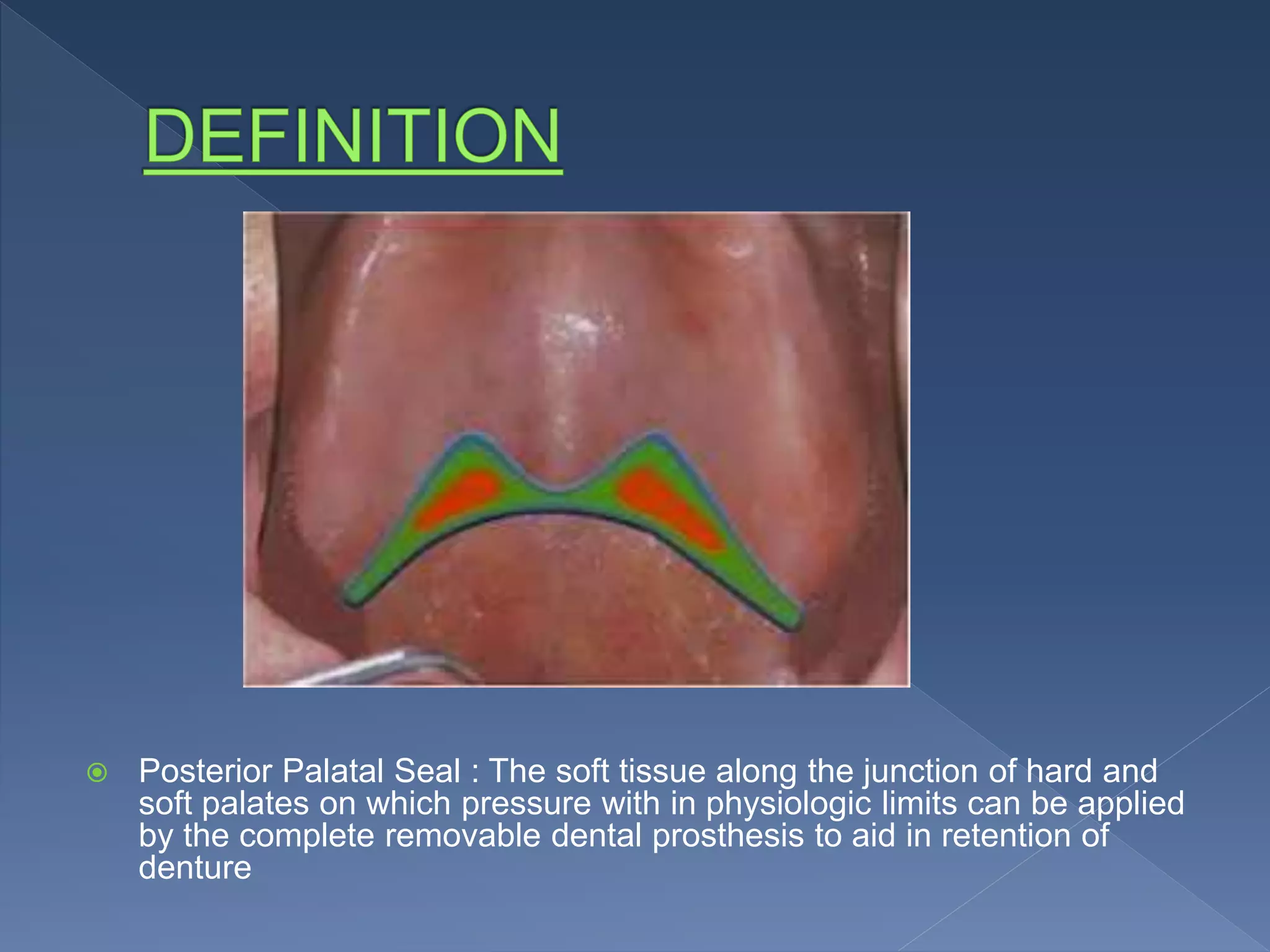 Posterior Palatal Seal Ppt