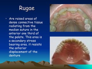 POSTERIOR_PALATAL_SEAL ppt PROSTHODONTICS | PPT