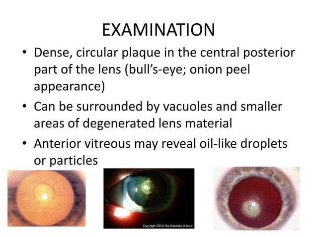 Posterior polar cataract | PPTX | Eye and Vision Conditions | Diseases ...
