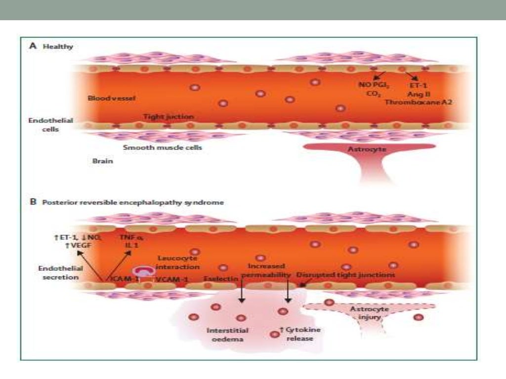 Pres syndrome recovery picture