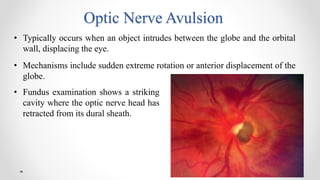 Posterior segment manifestations of blunt trauma-1.pptx