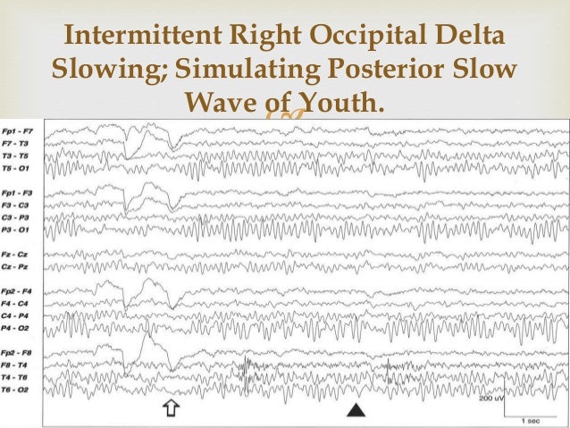 posterior slow waves of youth 10 638