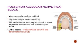 Posterior superior alveolar nerve block seminar.pptx