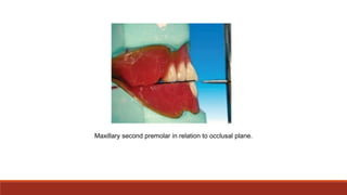 Maxillary second premolar in relation to occlusal plane.
 