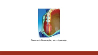 Placement of the maxillary second premolar.
 