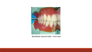 Mandibular second molar – front view.
 
