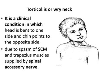 Torticollis or wry neck
• It is a clinical
condition in which
head is bent to one
side and chin points to
the opposite side.
• due to spasm of SCM
and trapezius muscles
supplied by spinal
accessory nerve.
 
