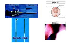 7.5 F storz Bugbee
Cold knife Hook
Ablation
Incision
 
