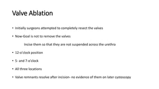 Valve Ablation
• Initially surgeons attempted to completely resect the valves
• Now-Goal is not to remove the valves
Incise them so that they are not suspended across the urethra
• 12-o'clock position
• 5- and 7-o'clock
• All three locations
• Valve remnants resolve after incision- no evidence of them on later cystoscopy
 