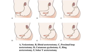 A, Vesicostomy. B, Distal ureterostomy. C, Proximal loop
ureterostomy. D, Cutaneous pyelostomy. E, Ring
ureterostomy. F, Sober Y ureterostomy
 