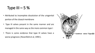 Type III – 5 %
• Attributed to incomplete dissolution of the urogenital
portion of the cloacal membrane
• Type III valves present in the same manner and are
managed in the same way as the more common type I
• There is some evidence that type III valves have a
worse prognosis ( Rosenfeld et al, 1994 ).
 