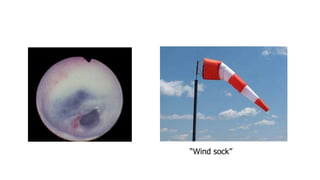 “Wind sock”
 
